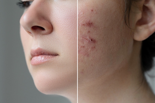 Acne is a skin disease that can happen at any type of age
