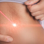 Laser stretch marks treatment