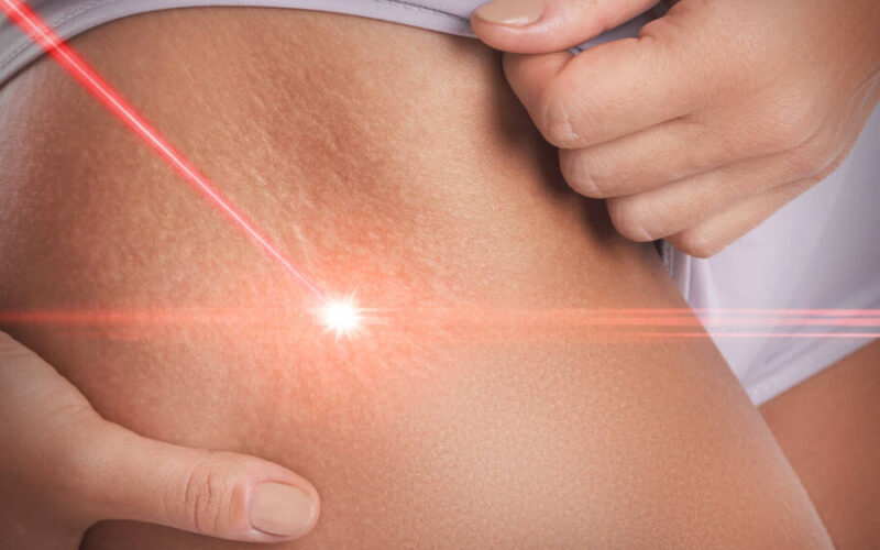 Laser stretch marks treatment
