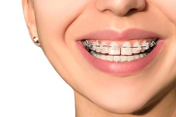Adult Orthodontic Treatment: What You Should Know?